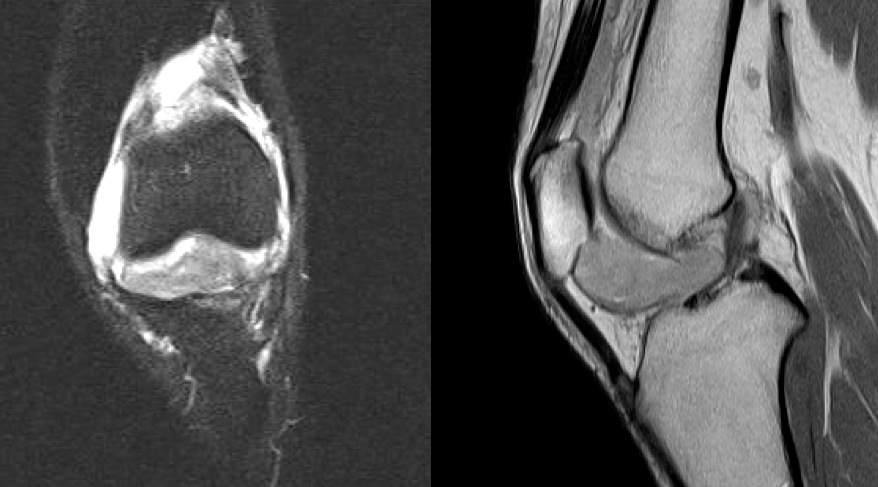 Figure 3 for case pigmented villonodular synovitis ( RID3641 )